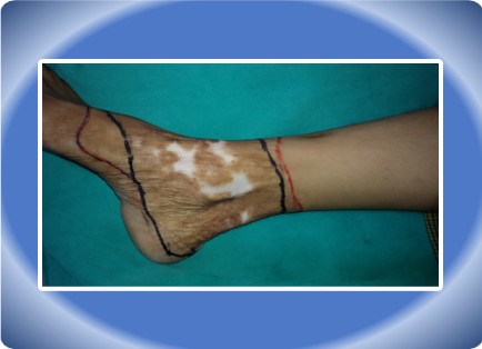 POST BURN SCAR
